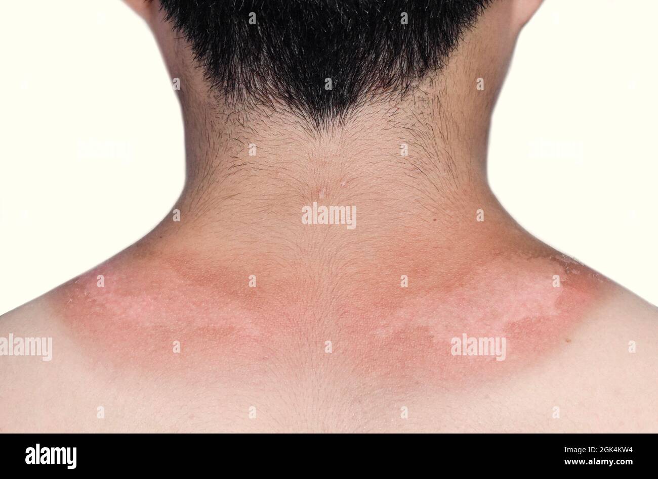 Sunburn peeling scolorimento o dermatite da scottatura solare nella parte superiore della parte posteriore del giovane asiatico. Foto Stock
