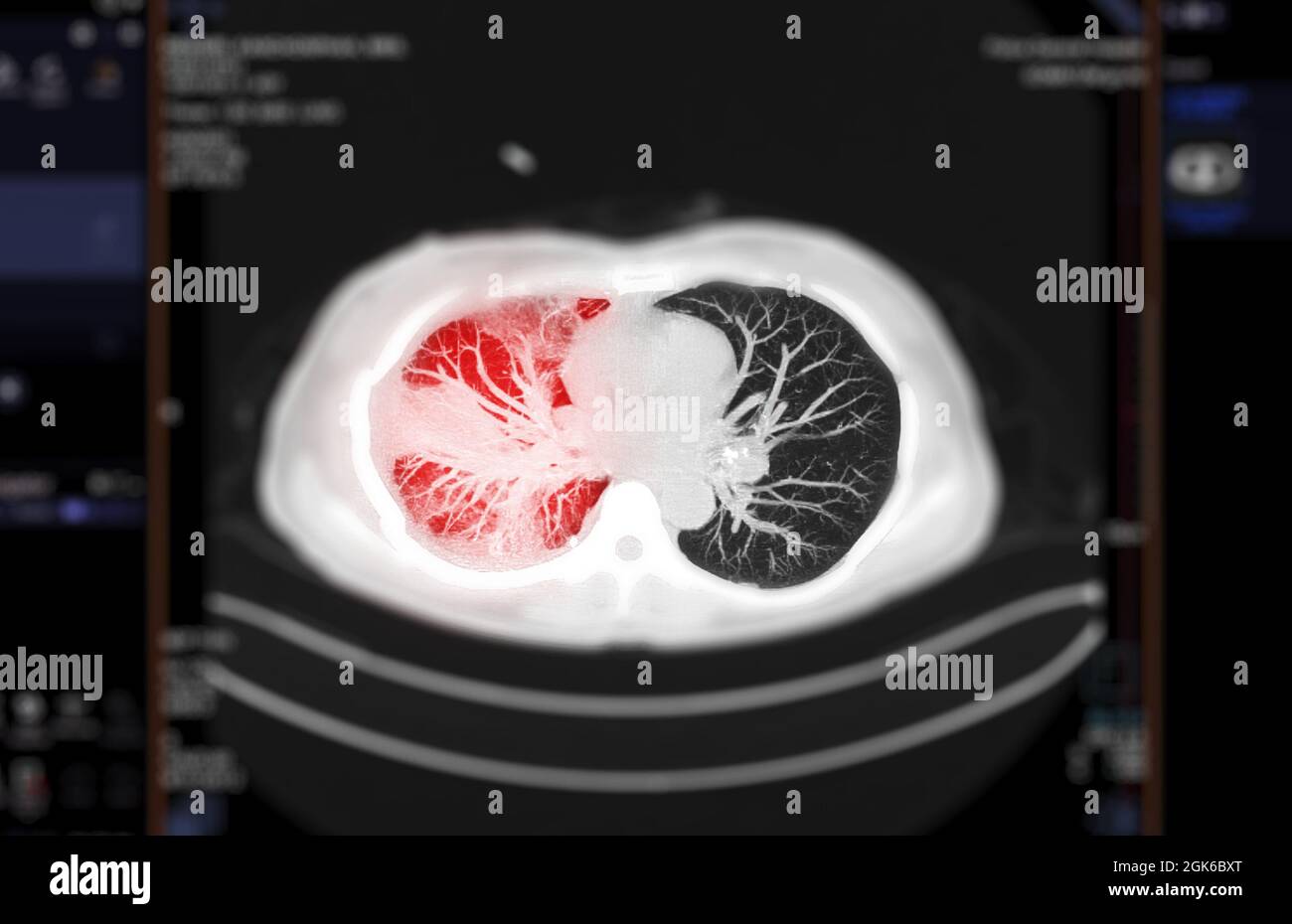 Fuoco selettivo della scansione TC della vista mip assiale toracica o  polmonare dell'infezione polmonare covid-19 con opacità del vetro  smerigliato Foto stock - Alamy