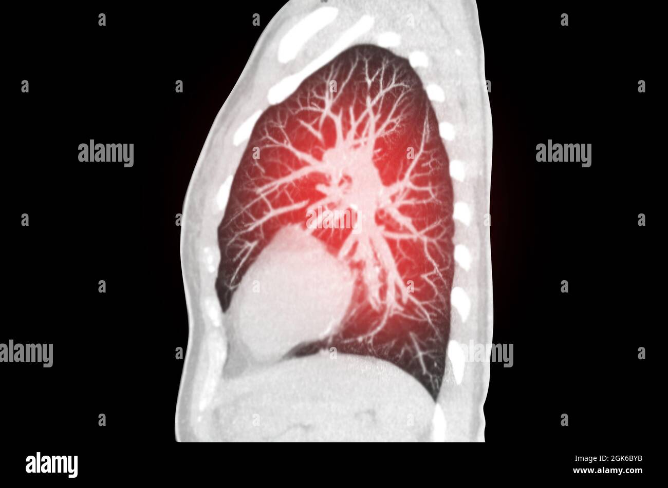 Scansione TC della vista mip sagittale toracica o polmonare dell'infezione polmonare covid-19 con opacità del vetro smerigliato . Foto Stock
