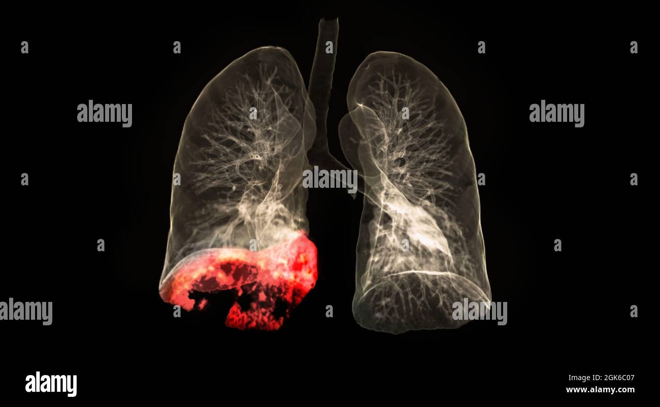 Scansione TC dell'immagine di rendering 3d del torace o del polmone che mostra l'infezione del polmone covid-19 nell'area del lobo inferiore destro isolata su sfondo nero. Foto Stock