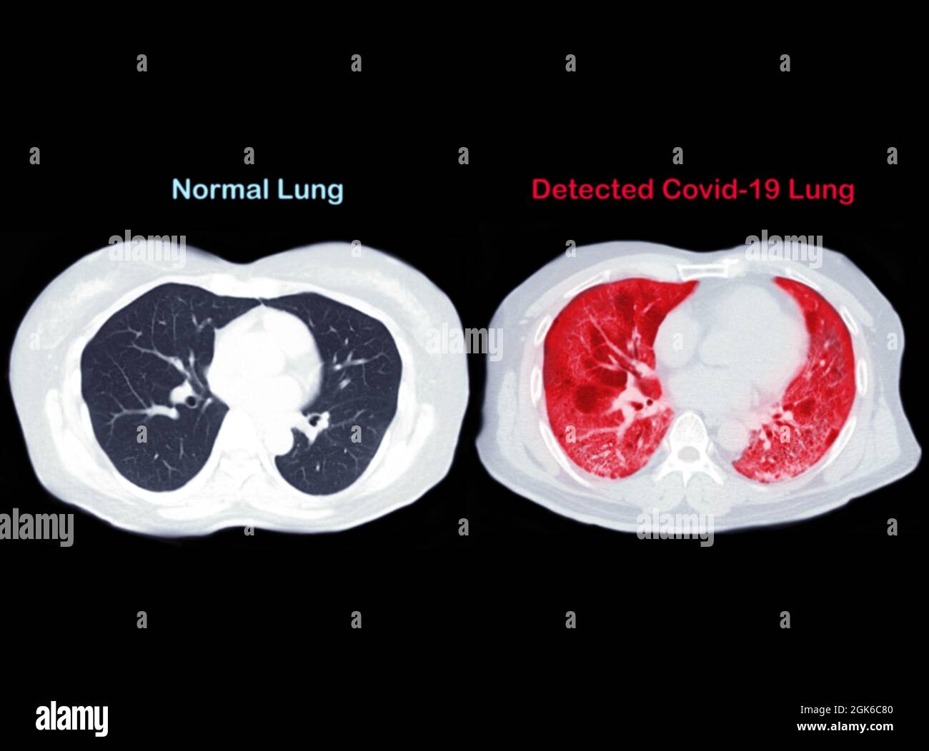 Confrontare la scansione TC della vista assiale toracica dell'infezione polmonare e polmonare normale covid-19 isolata su sfondo nero. Tracciato di ritaglio. Foto Stock