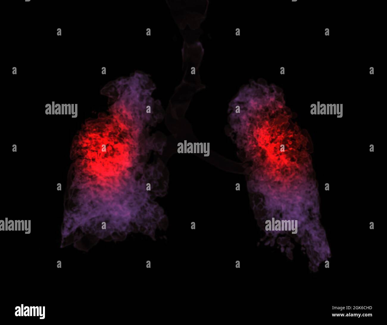 Rappresentazione TC Chest 3d che mostra infezione polmonare da covid-19. Foto Stock