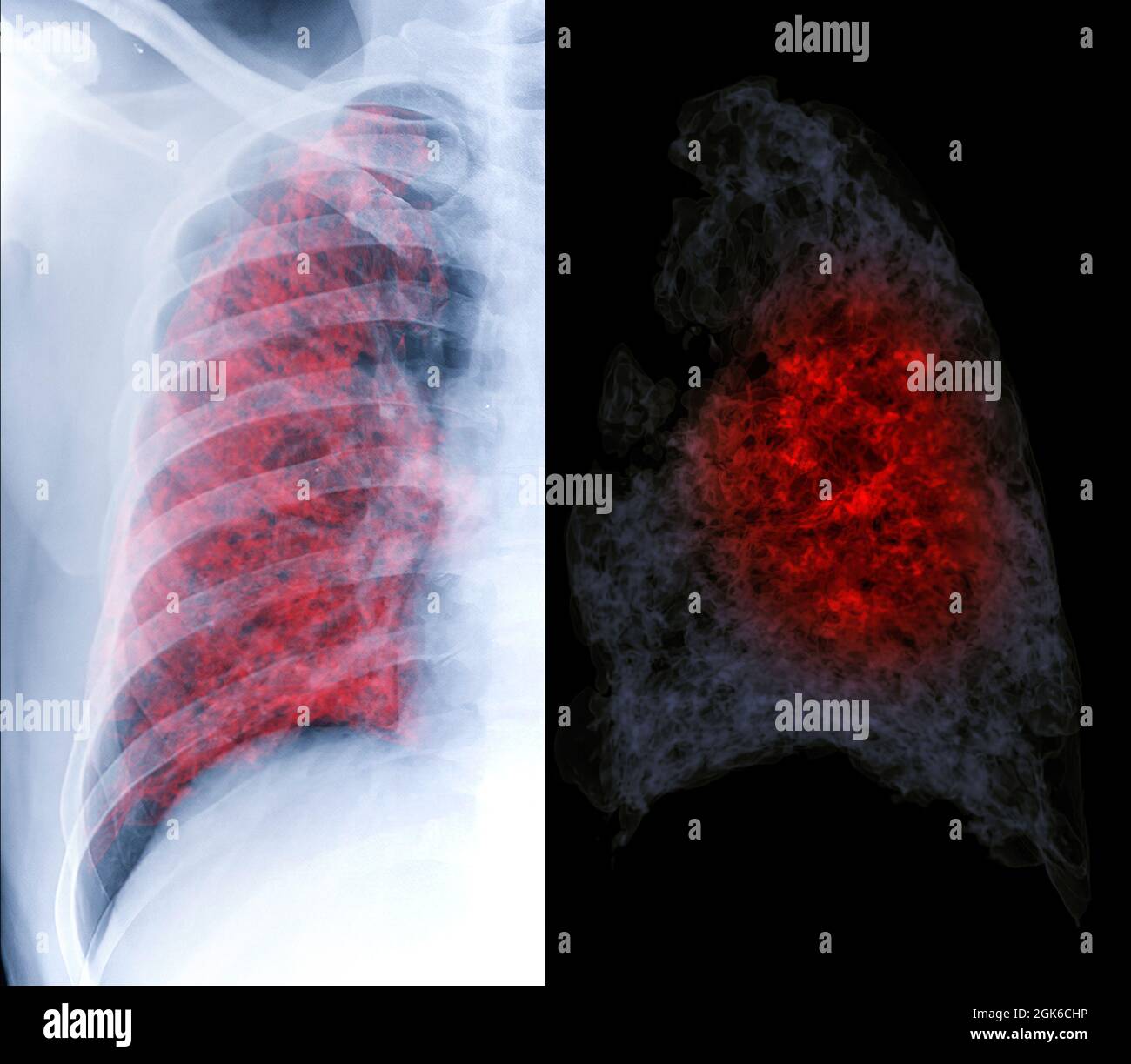 Confrontare il rendering 3d del torace e del torace del torace TC che mostra l'infezione polmonare da covid-19. Foto Stock