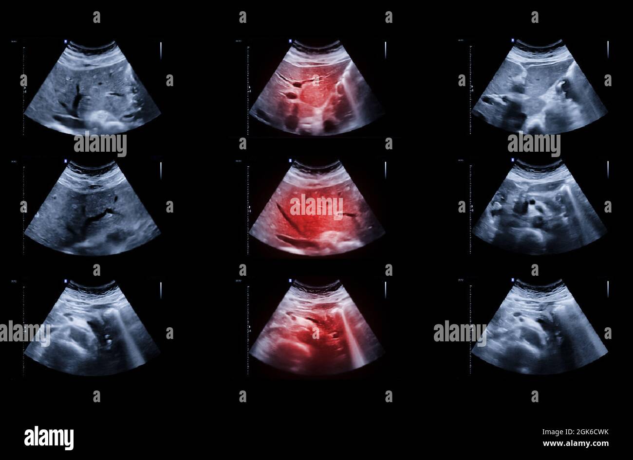 Ecografia dell'addome superiore che mostra fegato e cistifellea per lo screening del carcinoma epatico e calcoli biliari. Foto Stock