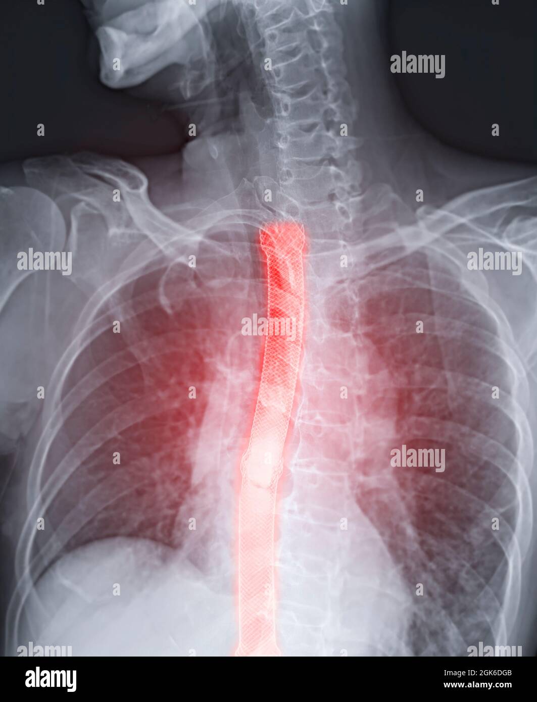 Immagine di esofagramma o di deglutizione di bario che mostra il posizionamento dello stent esofageo per il cancro esofageo del paziente. Foto Stock