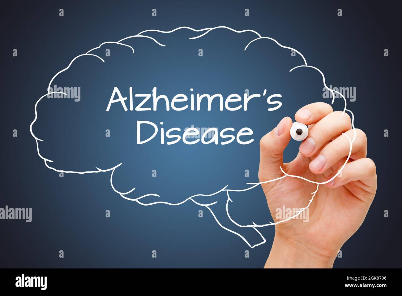 Scrittura a mano malattia di Alzheimer su cervello umano disegnato con marcatore bianco su sfondo blu scuro. Foto Stock