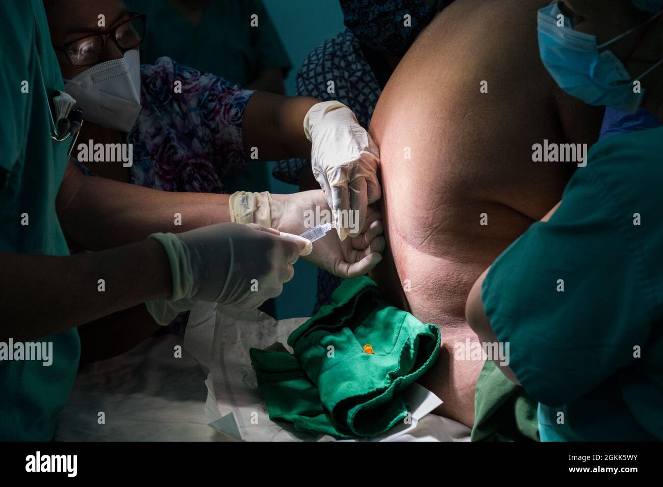 William Kogl, un anestesista infermiera con la Sezione chirurgica in avanti presso l'elemento medico, Joint Task Force-Bravo, Soto Cano Air base, Honduras, inietta un anestetico spinale prima della rimozione della cistifellea durante un esercizio di preparazione chirurgica per Resolute Sentinel 2021 a la Unión, El Salvador, maggio 12, 2021. Resolute Sentinel 21 è un'opportunità di formazione che offre vantaggi reali per aumentare la disponibilità medica e operativa della JTF-B, aiutando al contempo i cittadini salvadorani locali. Foto Stock