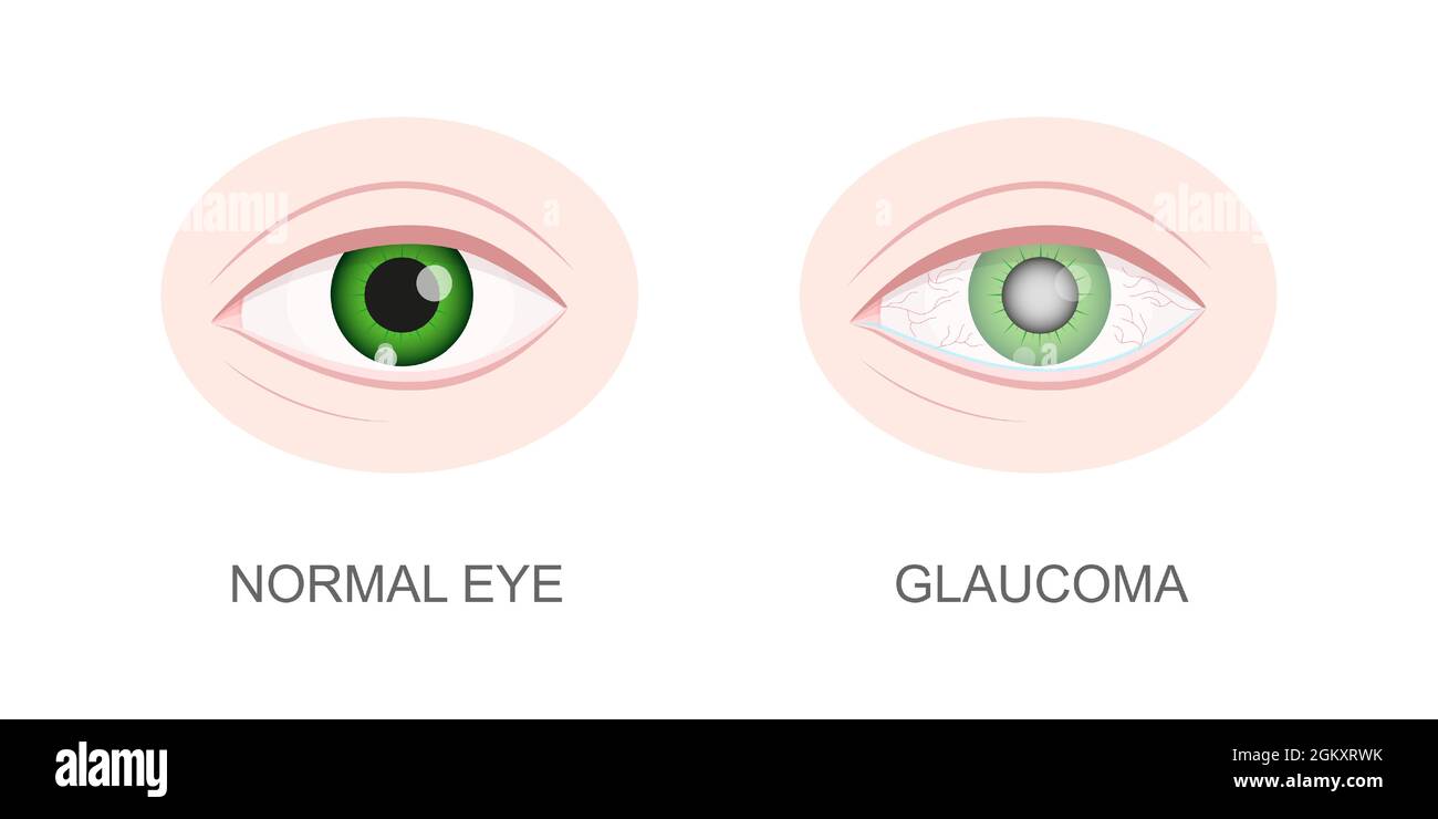 Occhio sano e con vista closeup glaucoma. Normale e nocciola, arrossamento, bulbo oculare acquoso. Organo visivo umano anatomicamente accurato. Problemi visivi di invecchiamento. Illustrazione di un cartoon vettoriale. Illustrazione Vettoriale