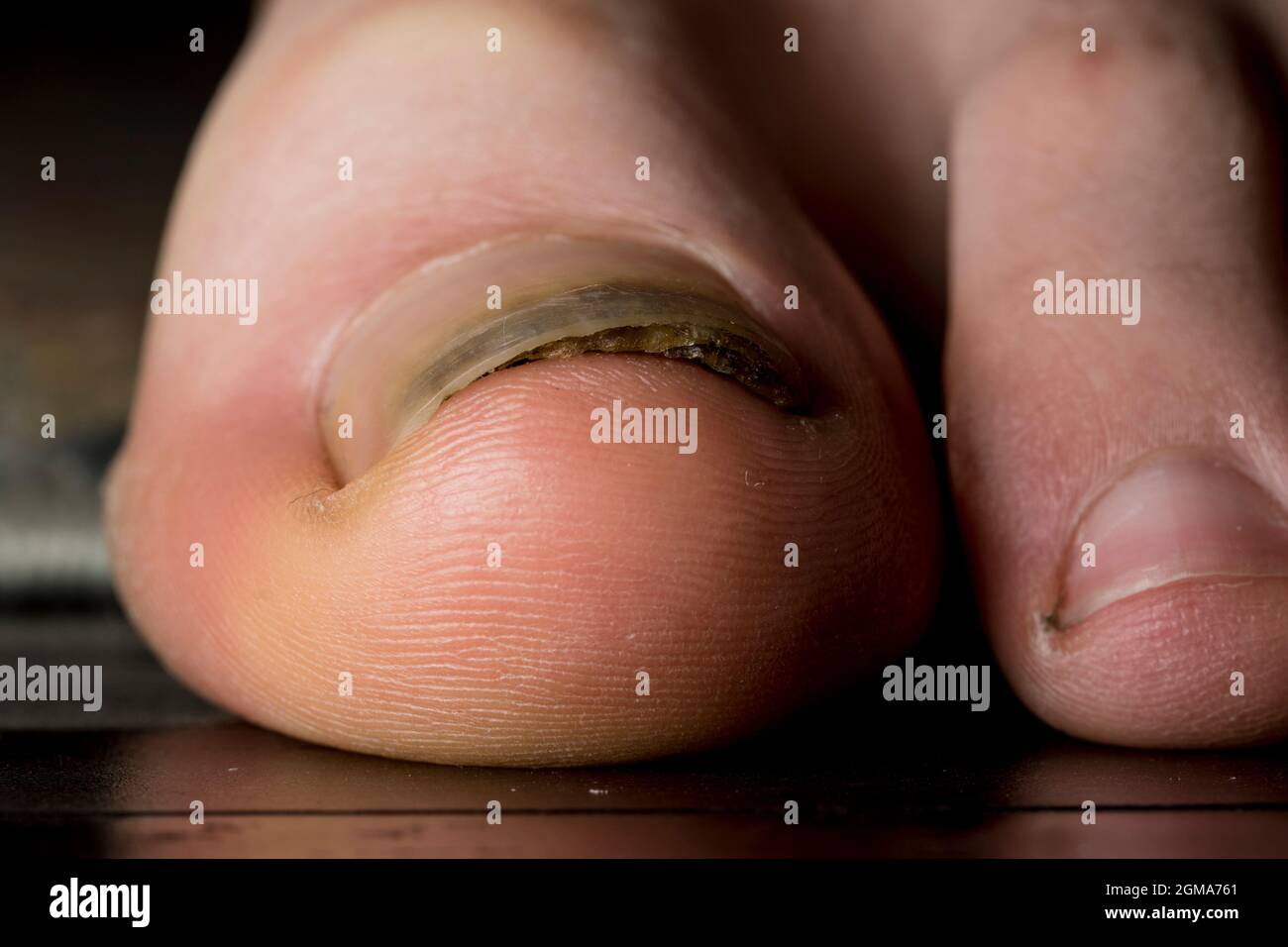 Trauma toenail del fungo dell'unghia della punta. Lesione del piede con separazione del chiodo dal letto del chiodo. Foto Stock