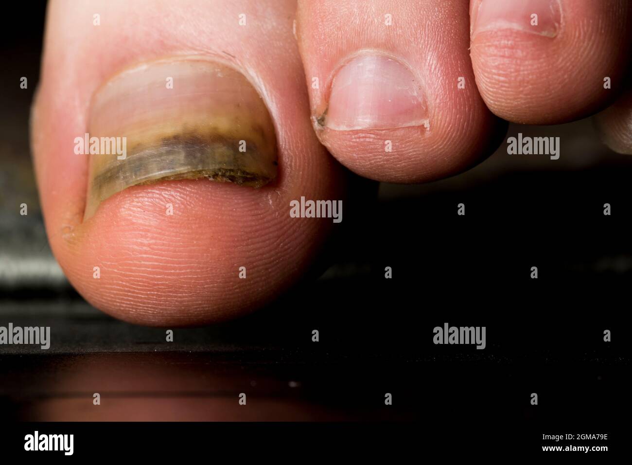 Lesioni alle unghie delle dita del piede rialzate da vicino. Crescita delle  unghie ispessita dovuta a lesioni e infezioni Foto stock - Alamy
