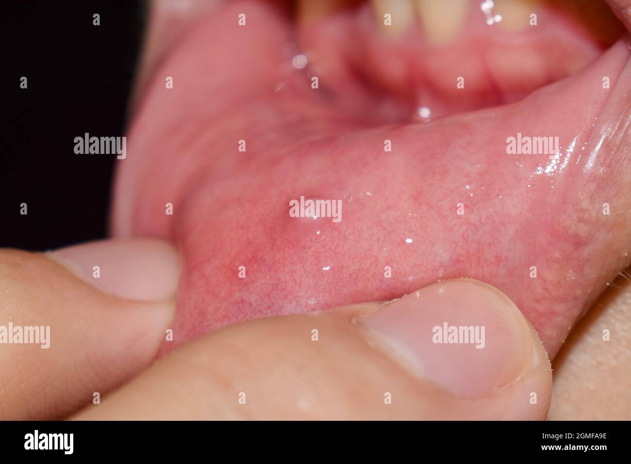 Piccola lesione della vescicola al labbro inferiore dell'uomo asiatico. Foto Stock