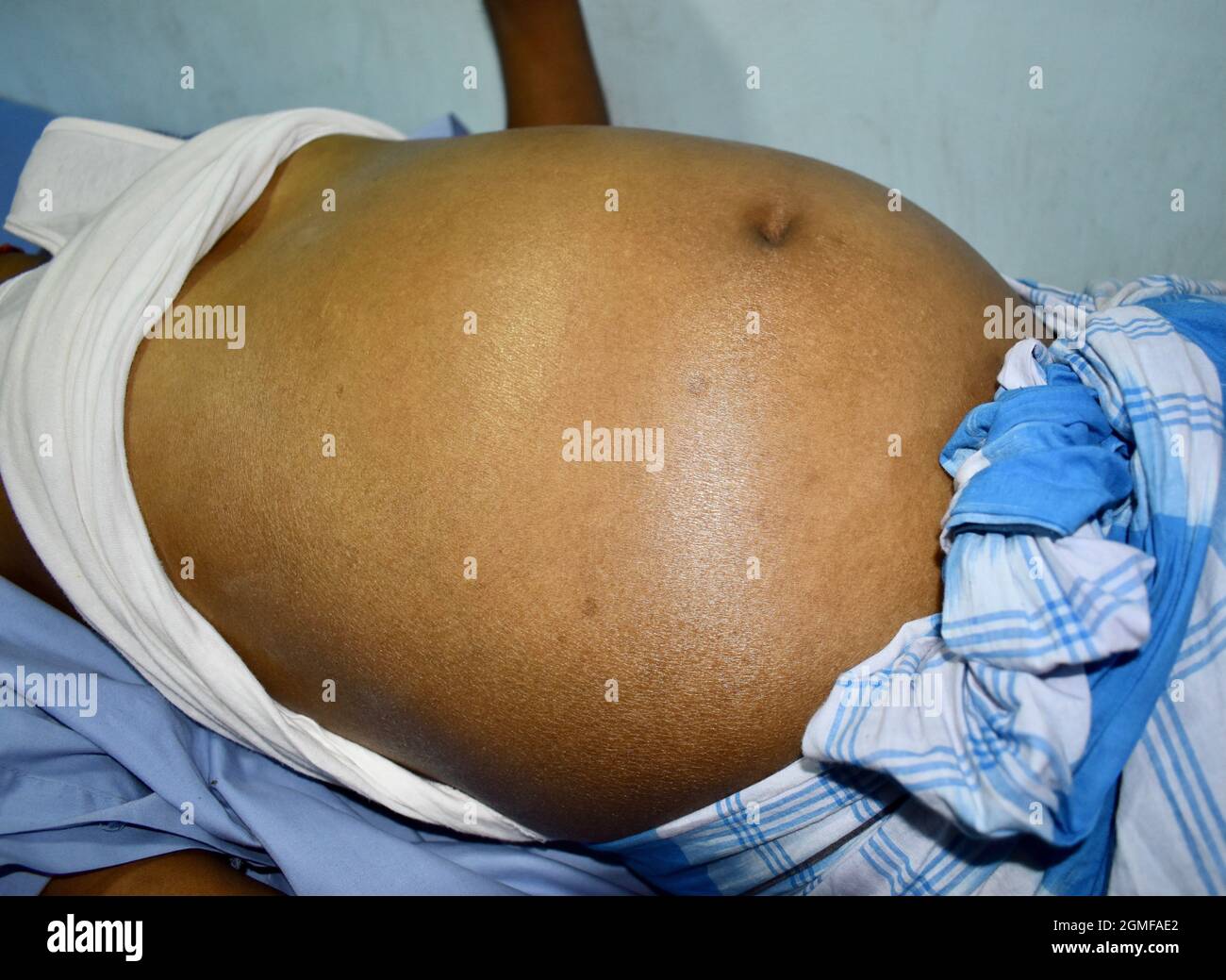 Grasso addominale in pazienti con asCittà. Il fianco è pieno. Foto Stock