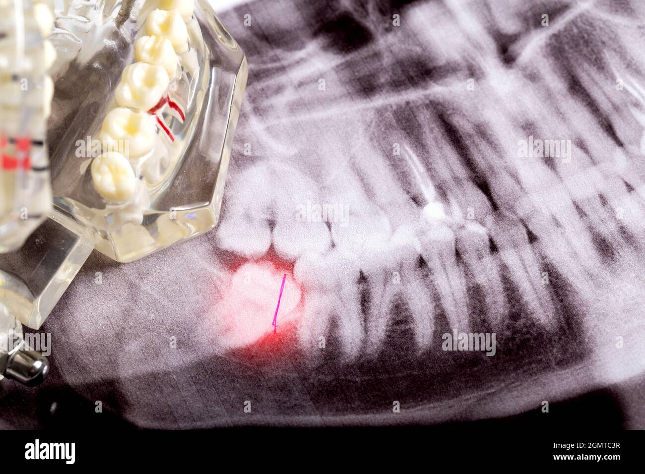 Ha influenzato i denti di saggezza su un'immagine a raggi X con un neoplasma della cisti infiammato. Rimozione dei denti di saggezza in odontoiatria Foto Stock
