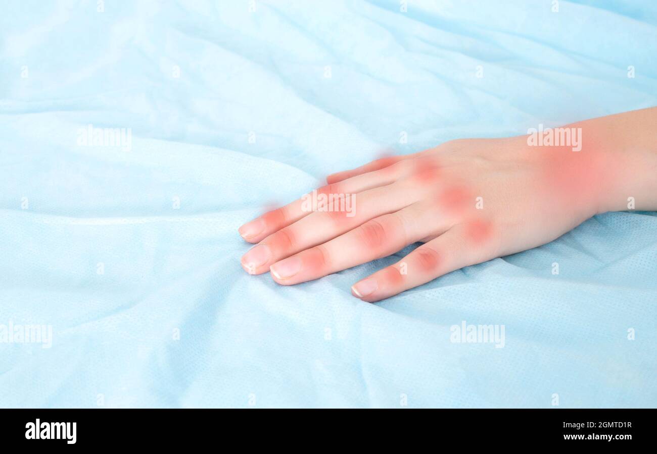 Mano di una donna su un tavolo blu con rossore nelle articolazioni della mano e delle dita. Concetto di malattia dell'artrite, infiammazione di piccoli susavs sull'h Foto Stock