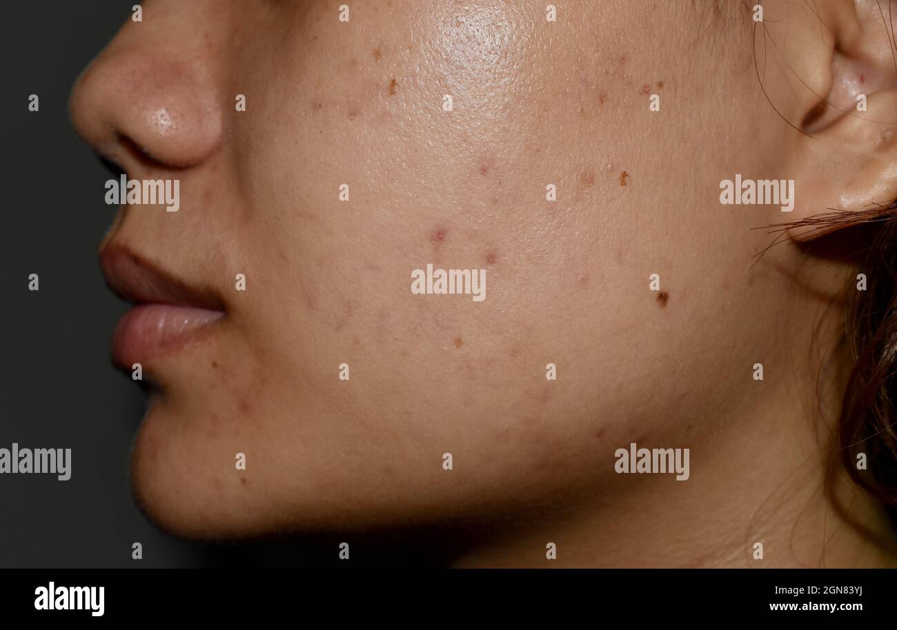 Cloasma o melasma , macchie nere e cicatrici acne sulla faccia della giovane donna asiatica. Foto Stock