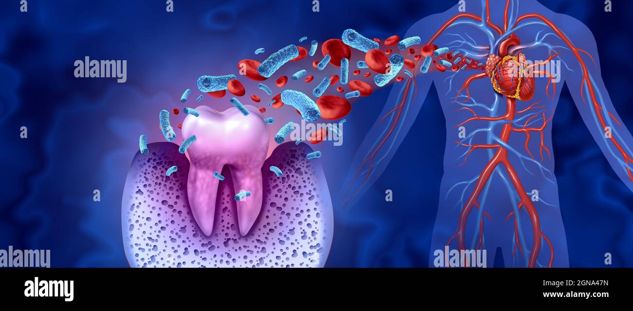 Carie dentarie e malattie cardiache come un molare malsano con parodontite a causa di problemi di salute di igiene orale scarsa come un'infezione batterica nel sangue. Foto Stock