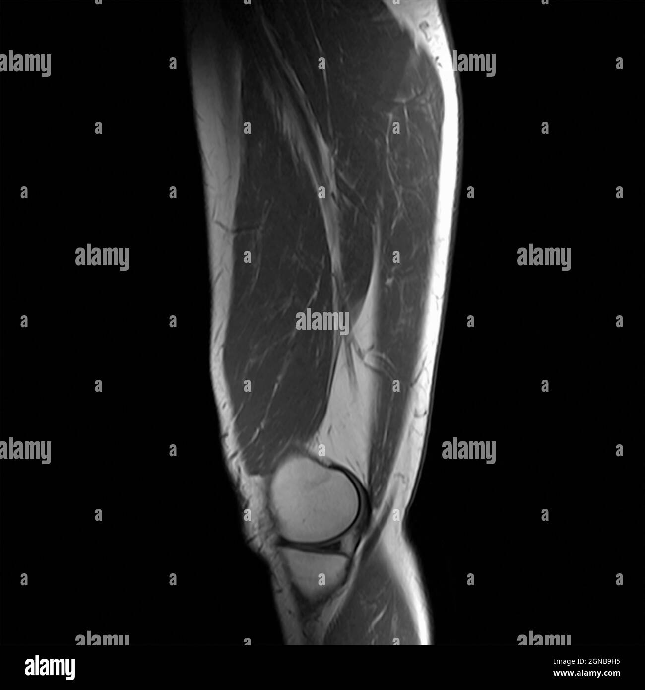 MRI della coscia maschile di un adulto Foto Stock