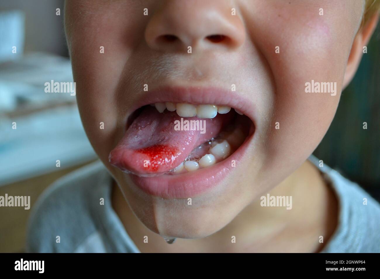 Primo piano di labbra, lingua, protrusione di sangue. Lingua morso del bambino. Foto Stock