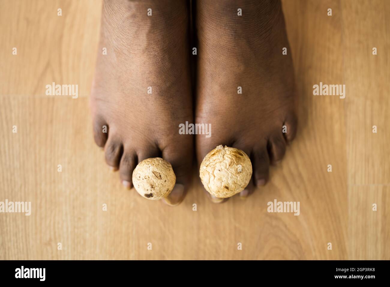 Fungo funghi tra Toenail. Piedi e funghi puzzolenti Foto Stock
