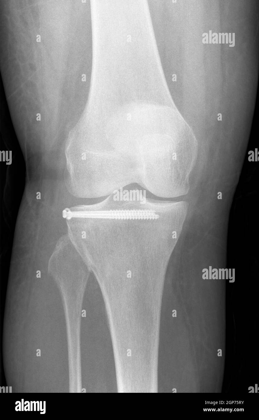 Radiografia di un paziente dopo frattura del plateau tibiale con due viti Foto Stock