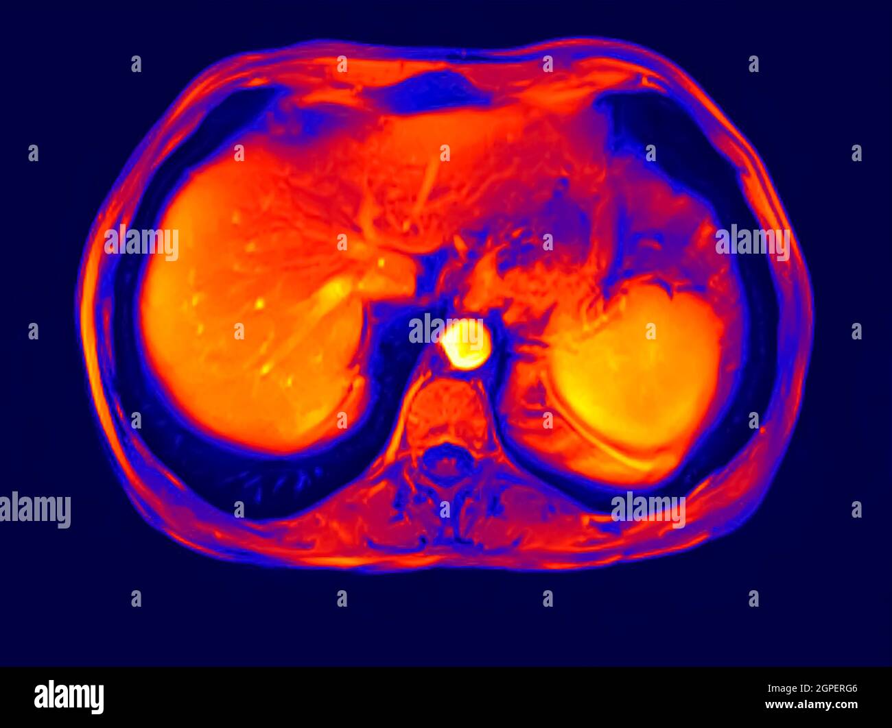 Sezione trasversale addome MRI scan di 60 anno vecchio paziente di sesso maschile. Questo paziente soffre di una pietra di rene Foto Stock