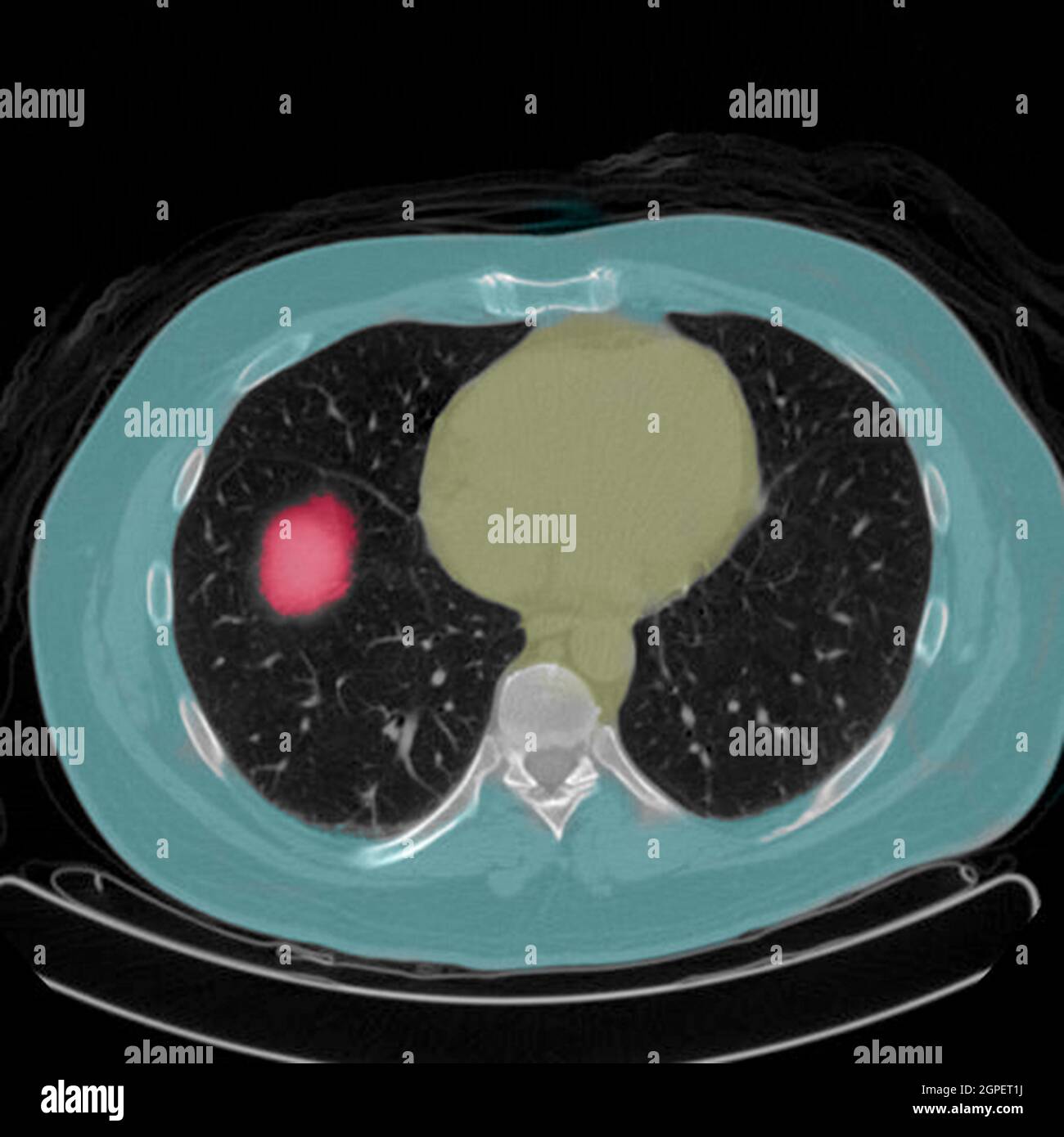 Scansione per tomografia a emissione di positroni (PET) di un paziente maschio di 54 anni. Un tumore può essere visto nel lobo superiore sinistro dei suoi polmoni Foto Stock