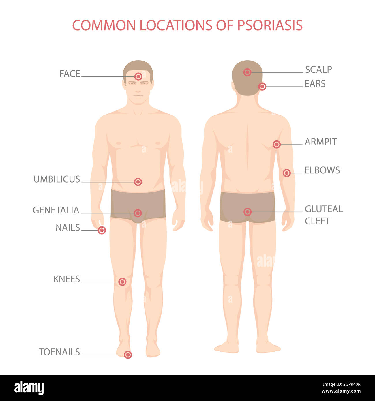 psoriasi, malattia della pelle del corpo umano Illustrazione Vettoriale