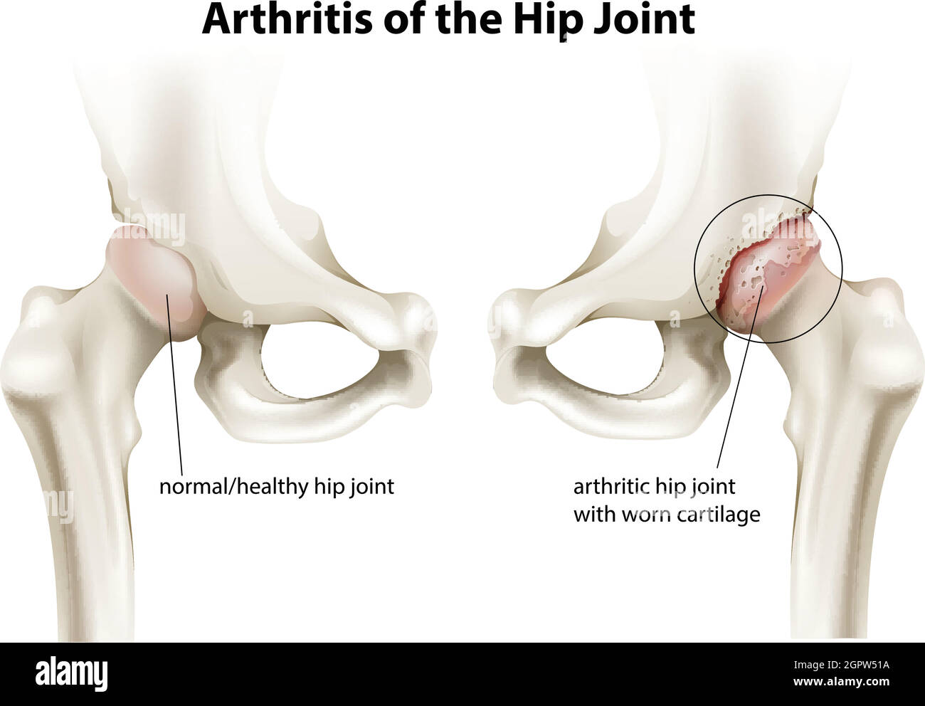 Artrite dell'articolazione dell'anca Illustrazione Vettoriale