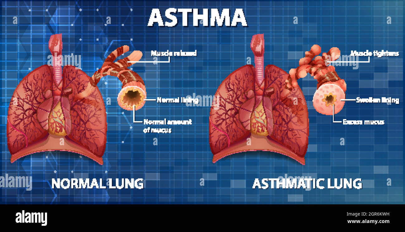 Confronto tra polmone sano e polmone asmatico Illustrazione Vettoriale