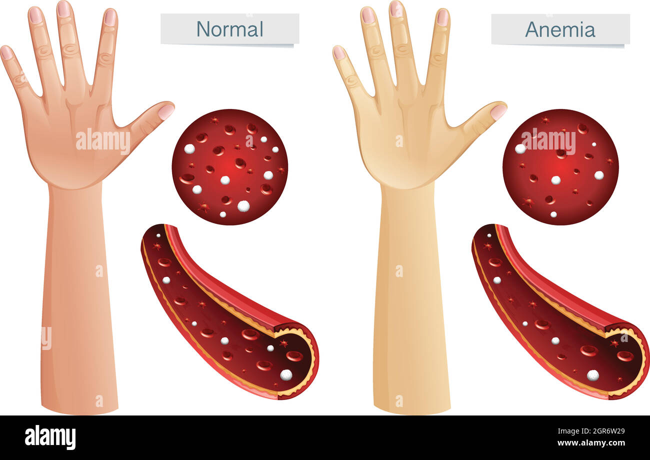 Anatomia umana vettore di anemia Illustrazione Vettoriale