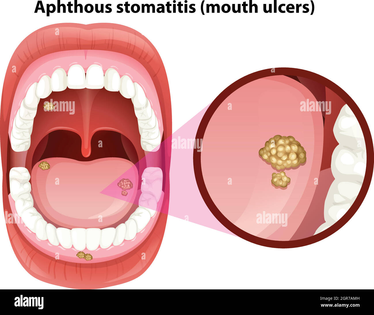 Anatomia della bocca umana delle ulcere Illustrazione Vettoriale