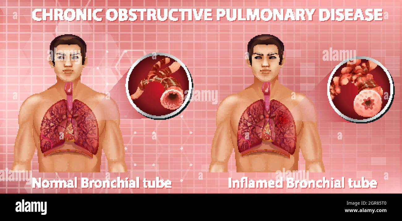 Modello Anatomico BPCO Malattia Polmonare GPI LFA #3110 - Per Studio E Formazione Medica