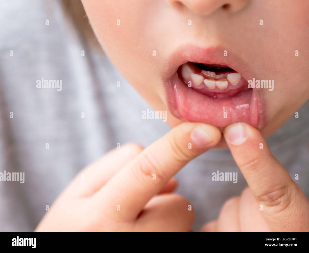Il bambino mostra una doppia fila di denti. I molari crebbero prima che i  denti del latte caddero fuori. Foto di Gums per dentista Foto stock - Alamy