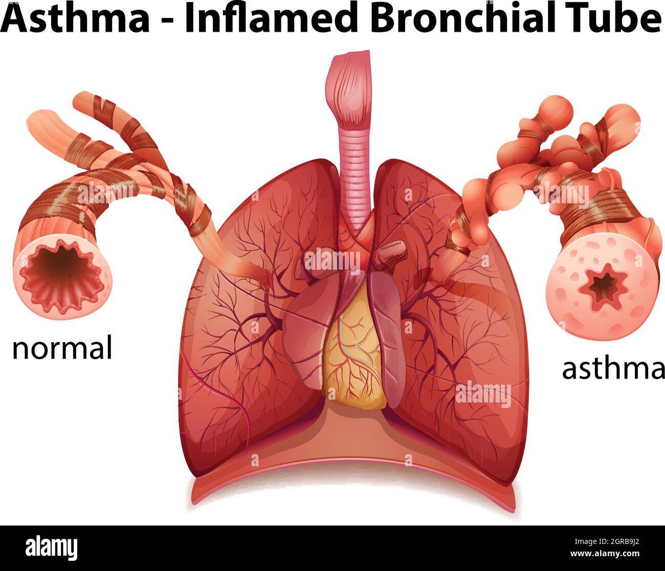 Asma bronchiale Illustrazione Vettoriale