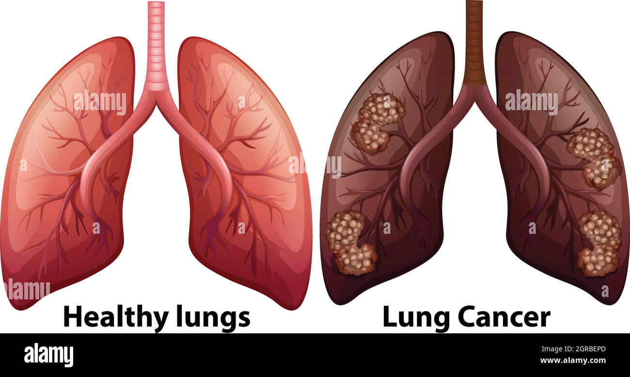 Anatomia umana della condizione polmonare Illustrazione Vettoriale