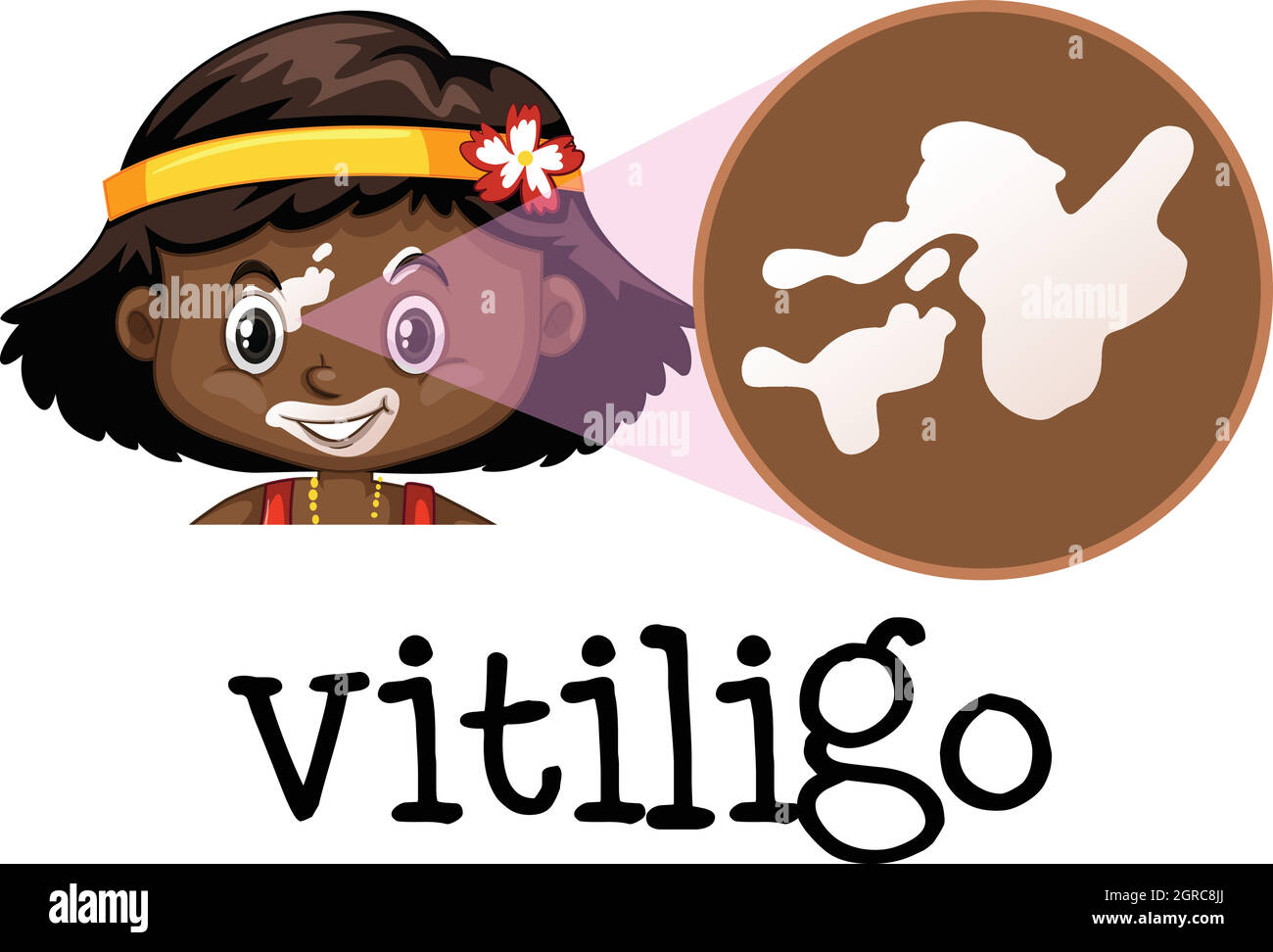 Educazione medica umana di Vitiligo Illustrazione Vettoriale