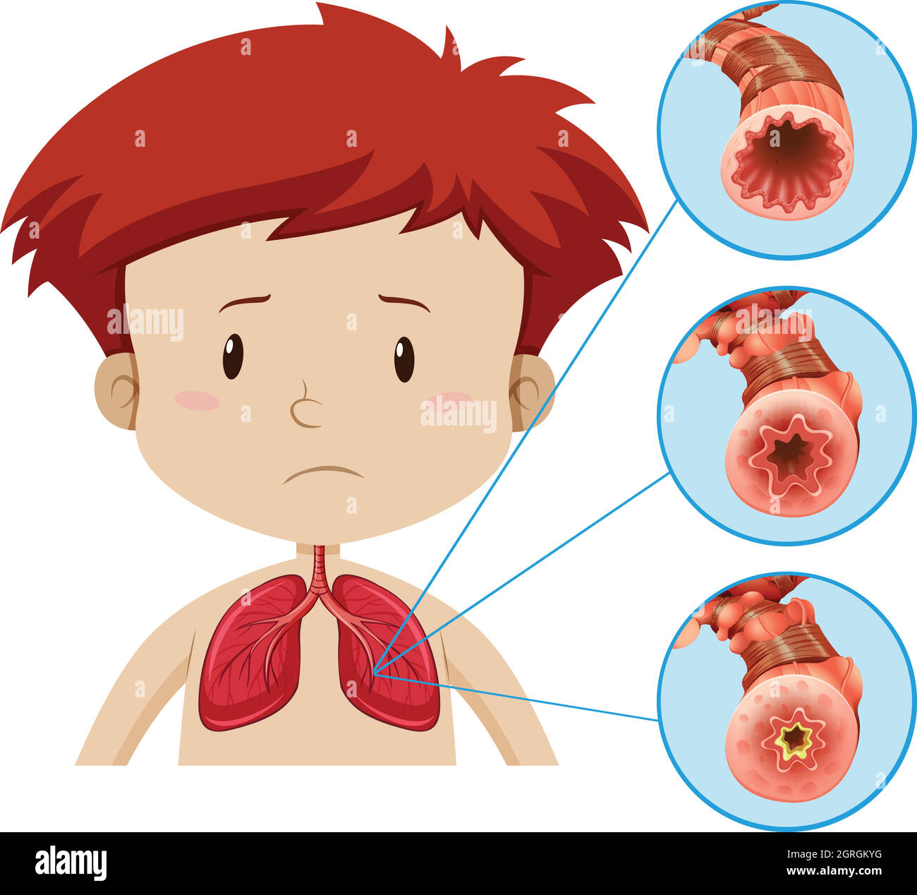 Un'anatomia umana del problema polmonare Illustrazione Vettoriale