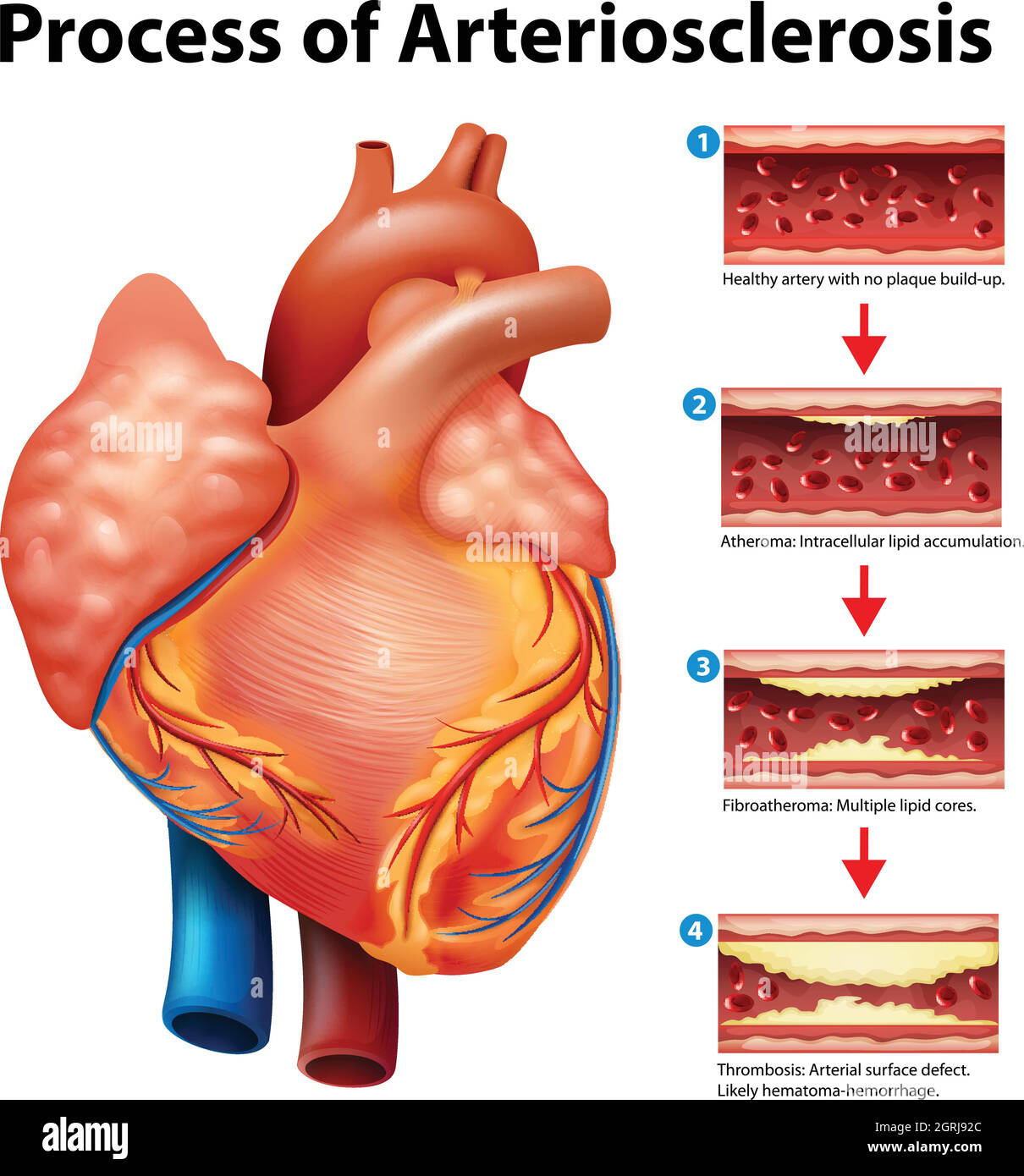 Processo di arteriosclerosi Illustrazione Vettoriale