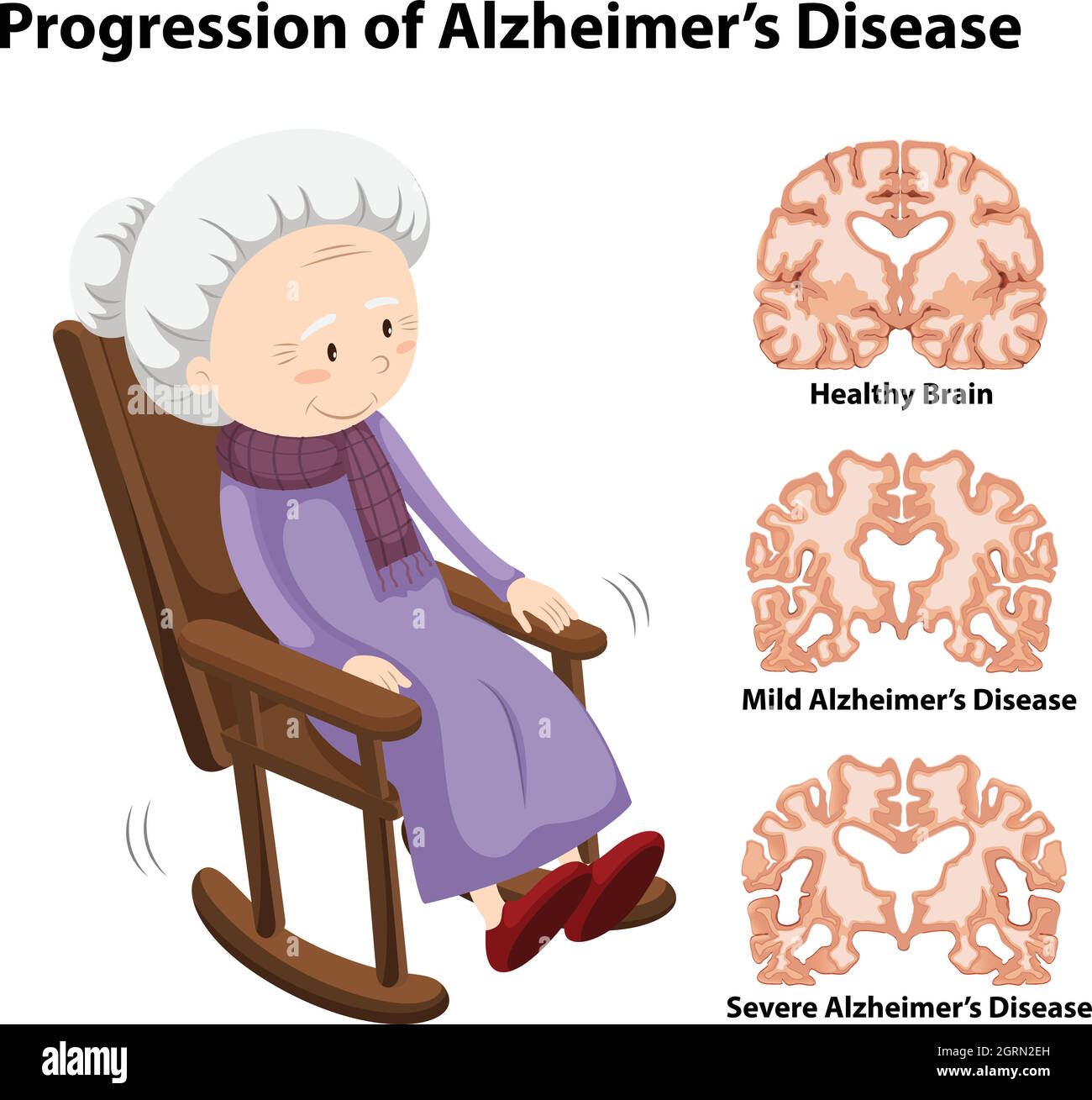 Progressione della malattia di alzheimer Illustrazione Vettoriale