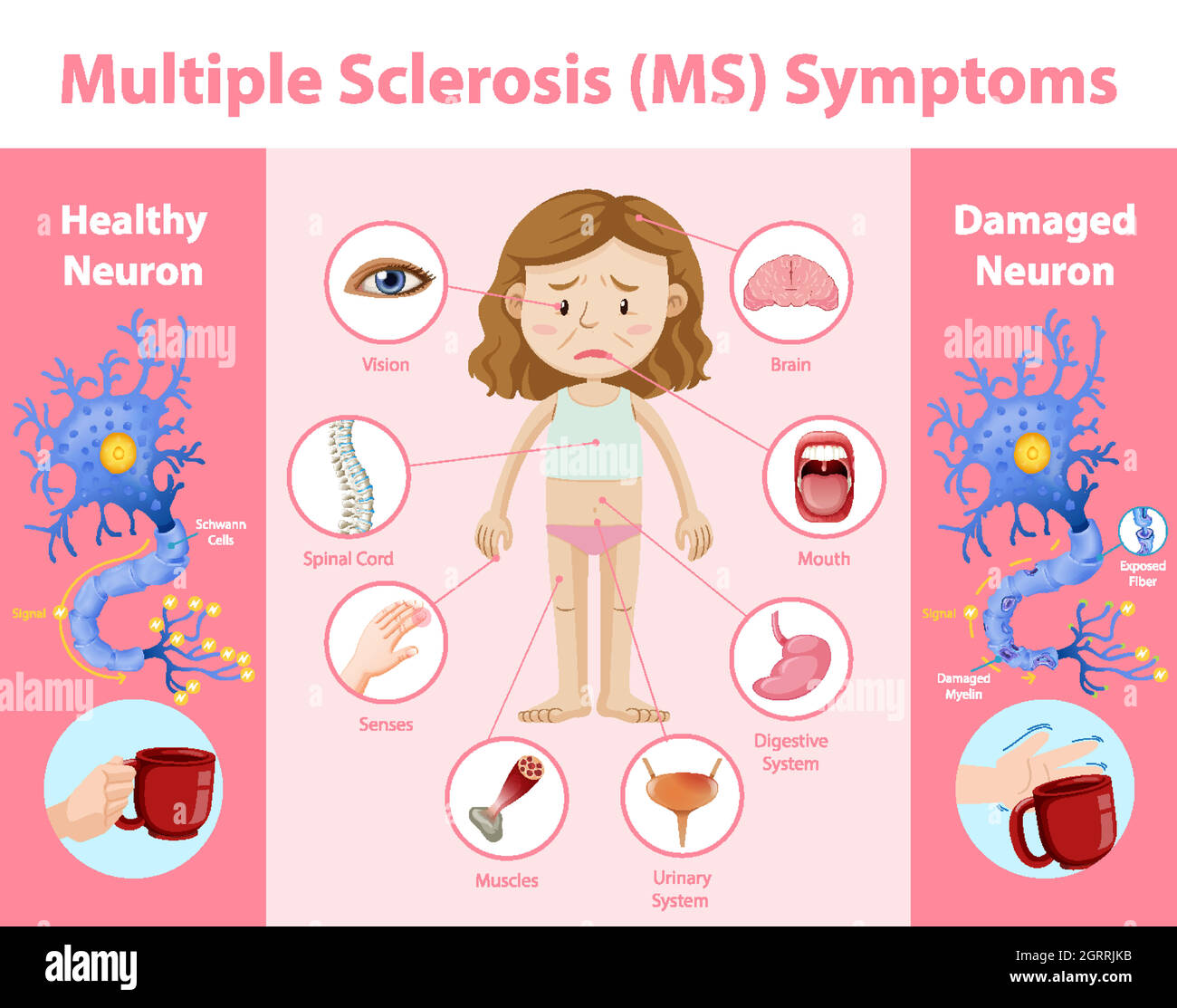 Infografica sui sintomi della sclerosi multipla (MS) Illustrazione Vettoriale