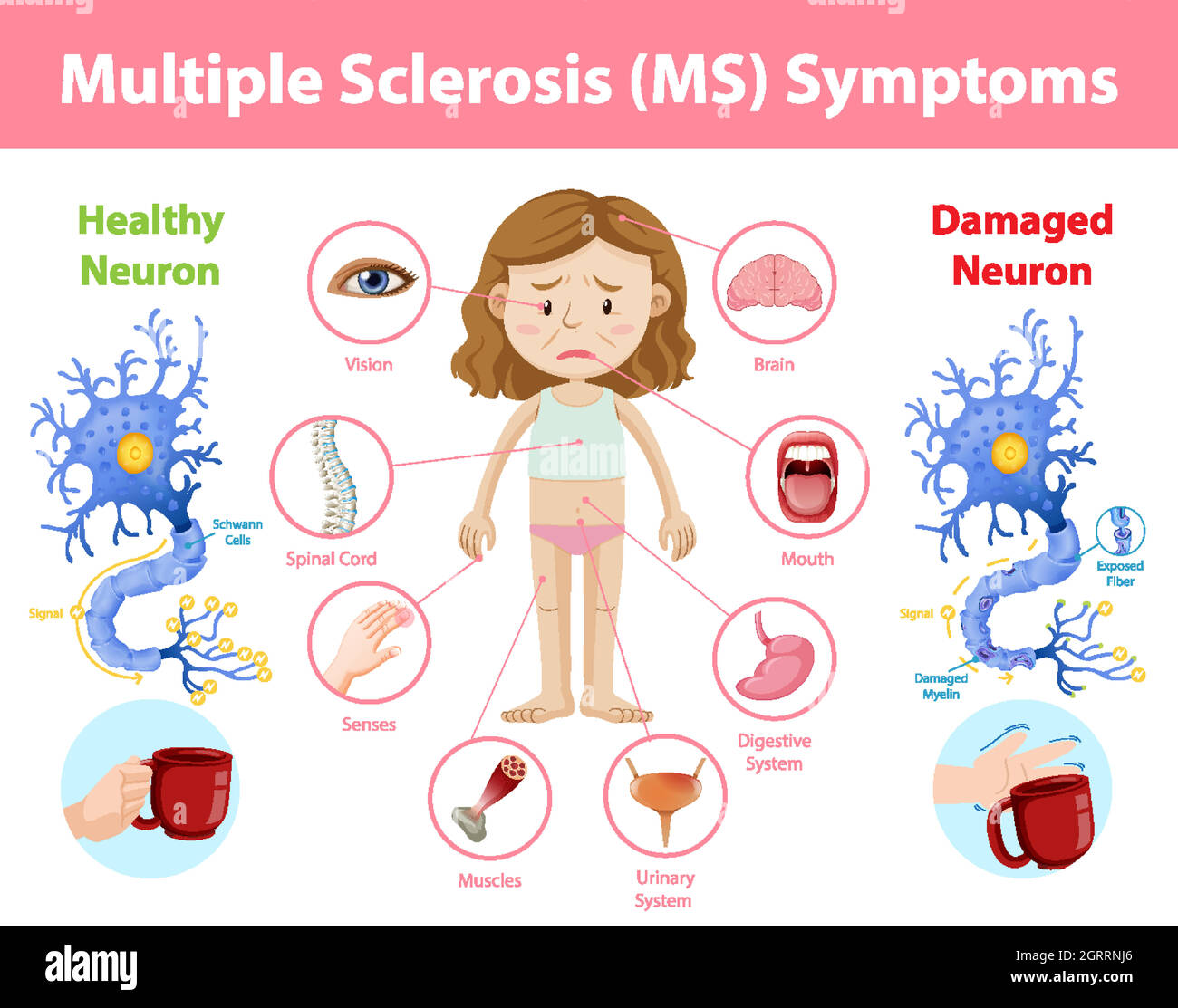 Infografica sui sintomi della sclerosi multipla (MS) Illustrazione Vettoriale