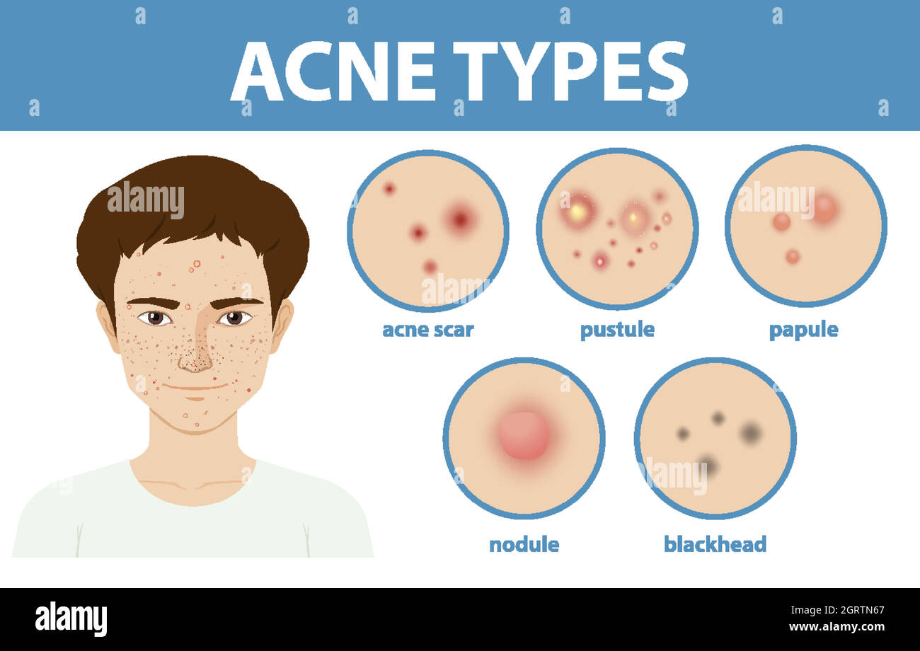 Tipi di acne sulla pelle o pimples Illustrazione Vettoriale