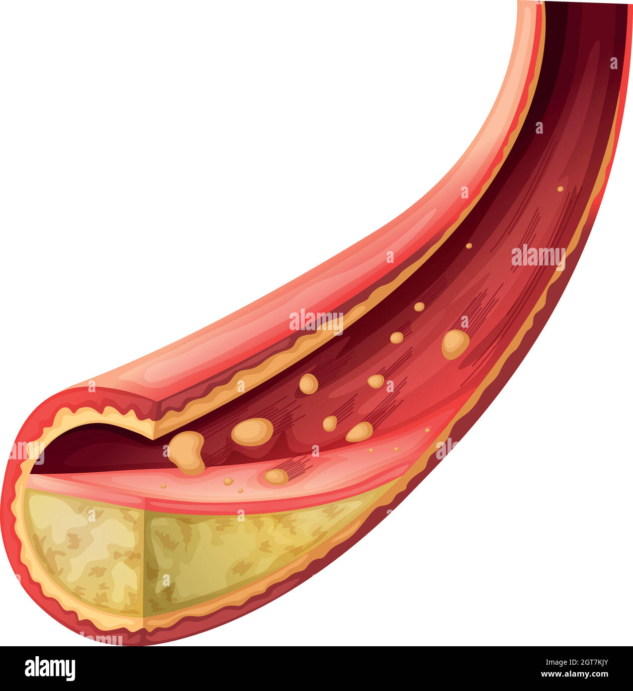 Arteria bloccata con colesterolo Illustrazione Vettoriale