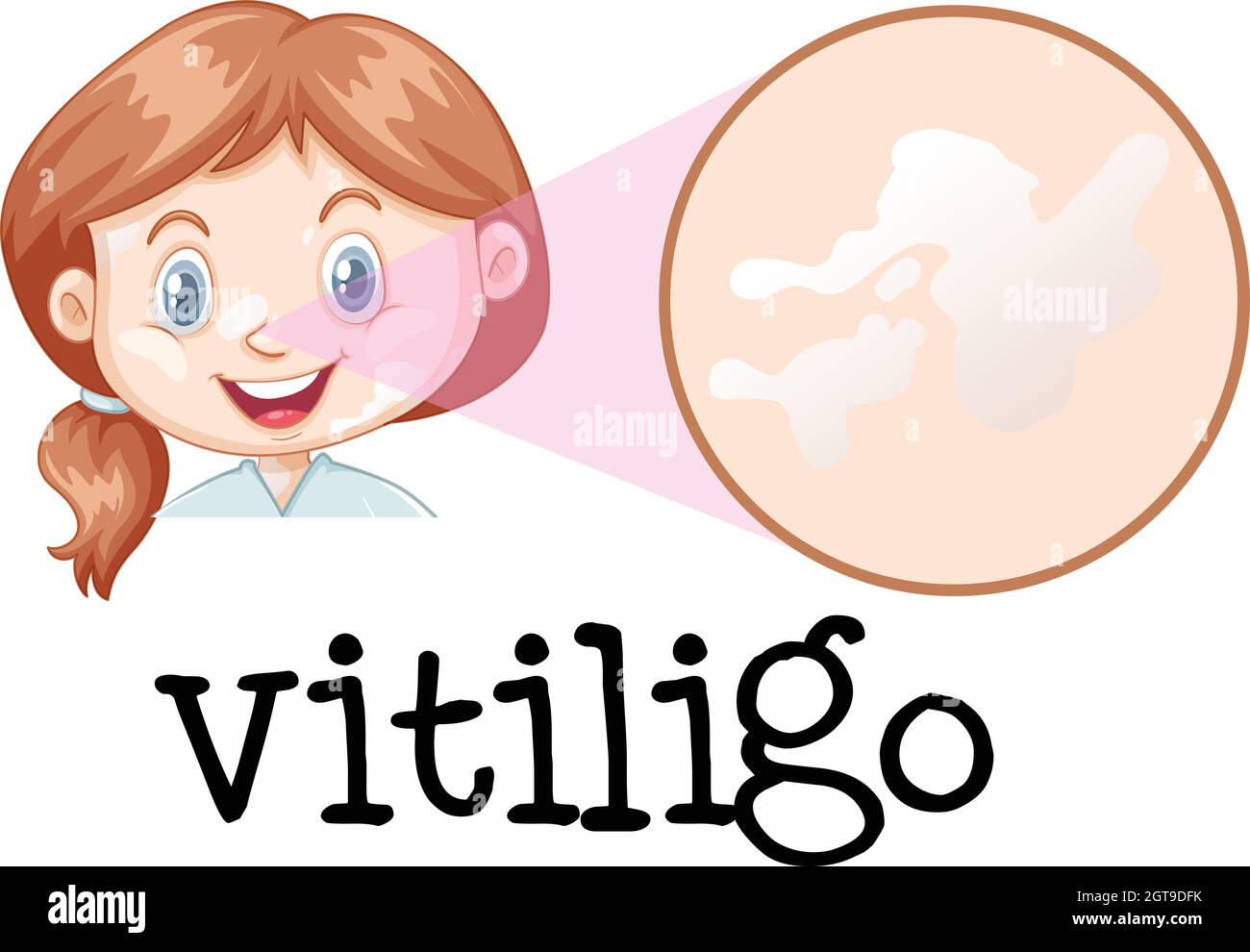 Una faccia della ragazza con Vitiligo Illustrazione Vettoriale