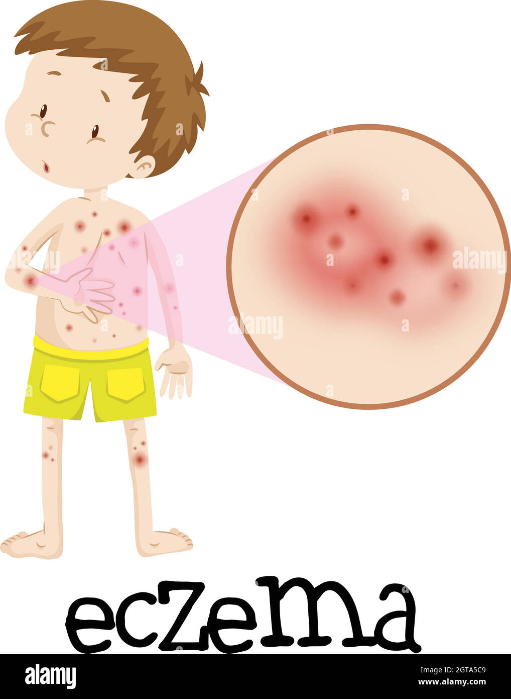 Educazione medica umana di Eczema Illustrazione Vettoriale