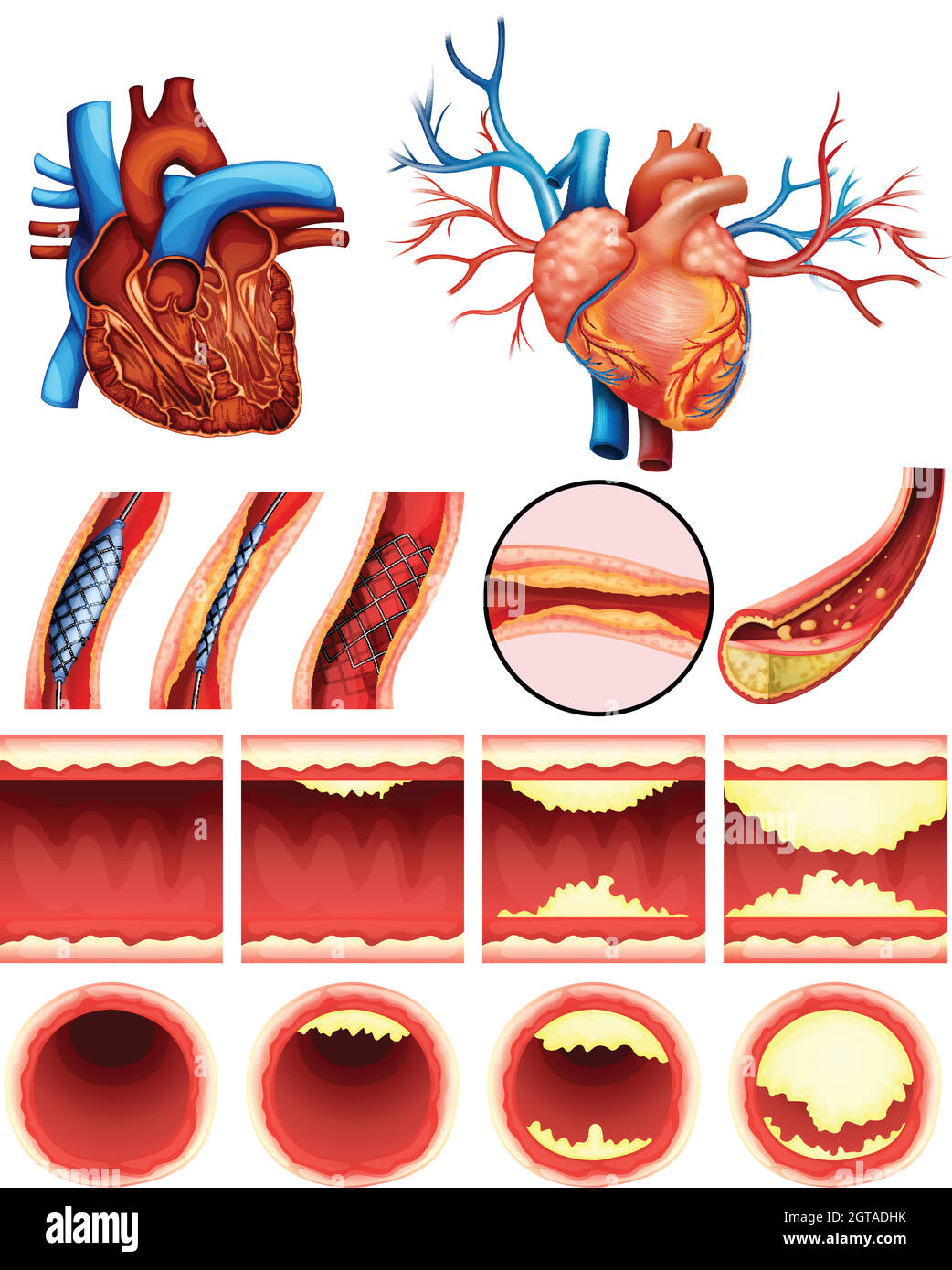 Colesterolo del cuore Illustrazione Vettoriale