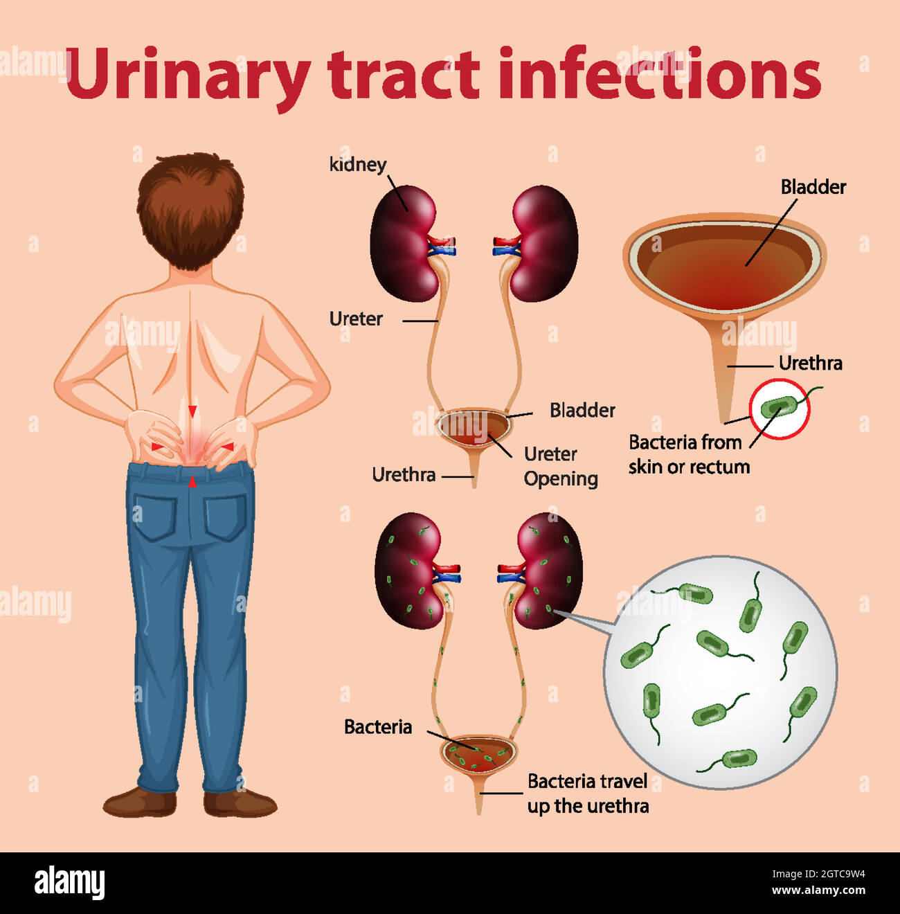 Illustrazione informativa delle infezioni del tratto urinario Illustrazione Vettoriale