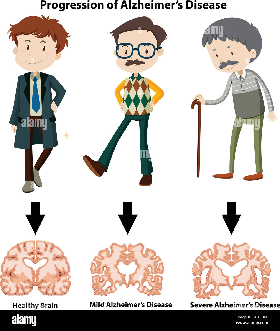 Una progressione della malattia di Alzheimer Illustrazione Vettoriale