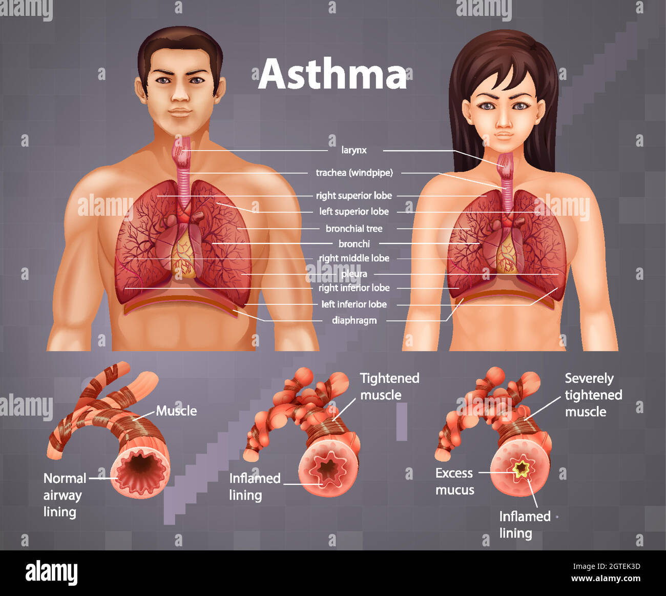 Confronto tra polmone sano e polmone asmatico Illustrazione Vettoriale