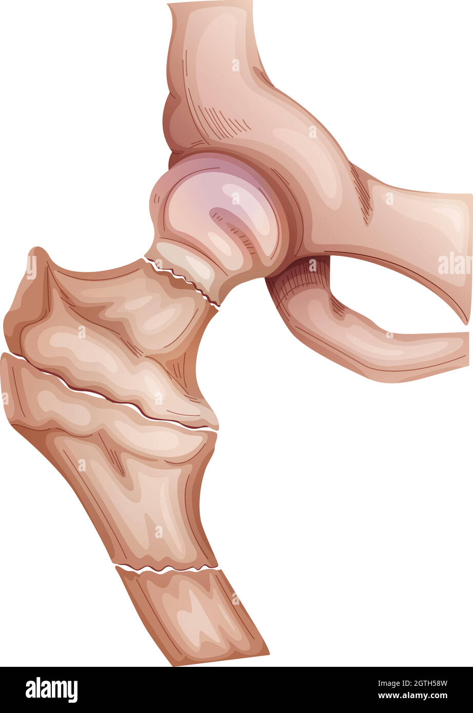 Fratture dell'anca Illustrazione Vettoriale
